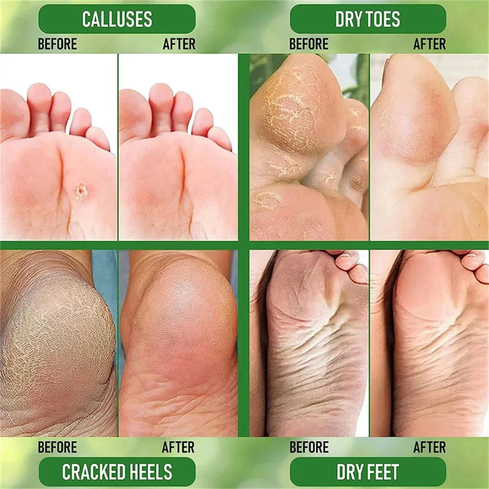 Herbal Anti-Crack Foot Cream - Heel Repair & Dead Skin Removal