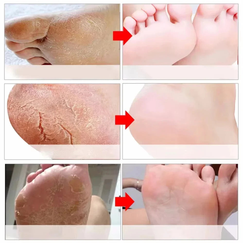 Herbal Anti-Crack Foot Cream - Heel Repair & Dead Skin Removal