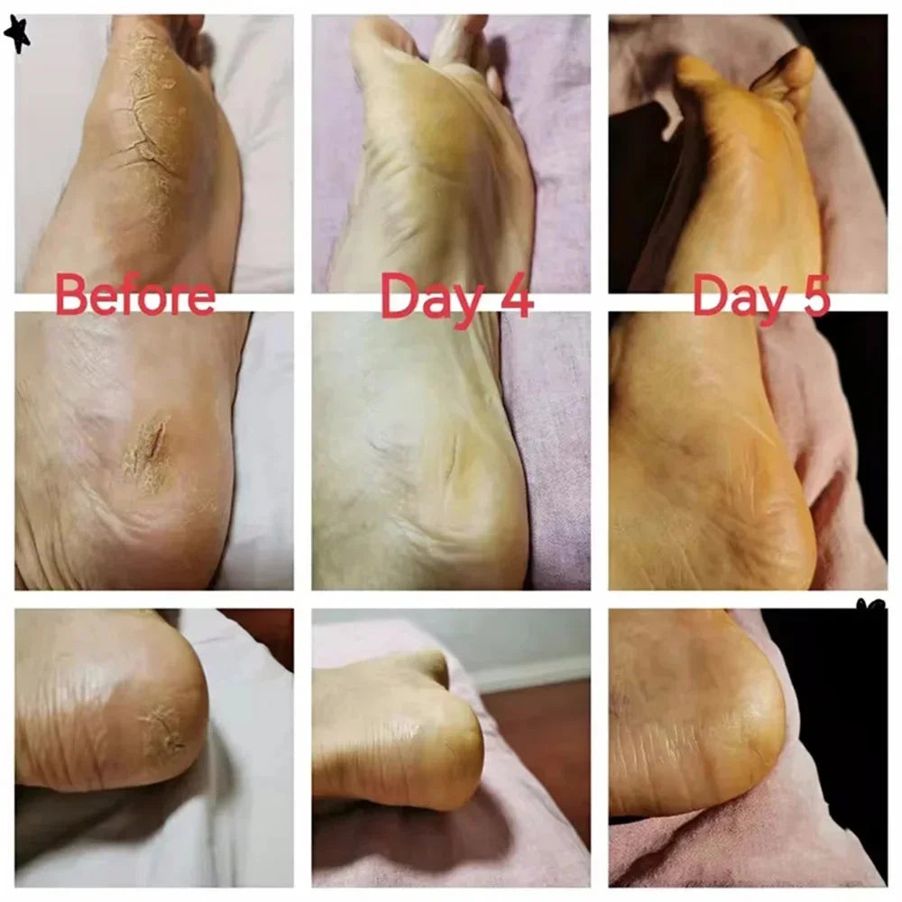 Herbal Anti-Crack Foot Cream - Heel Repair & Dead Skin Removal